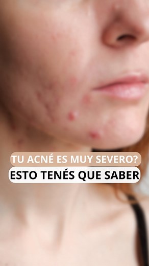 Dra. Daniela Pascali ⚕ | Escucharon hablar alguna vez del acné conglobata? . Les cuento en este video. . 👉🏻#consultacontudermatóloga . . . #drapascali #skincare... | Instagram