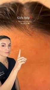 Forehead Bumps: Clogged Pores or Fungal Acne? Here’s How to Tell