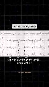 [OSCE: ECG Interpretation] What is the ECG diagnosis here?