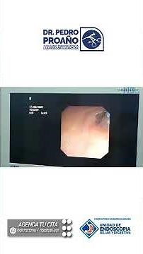 CPRE (COLANGIOPANCREATOGRAFÍA RETRÓGRADA ENDOSCÓPICA)