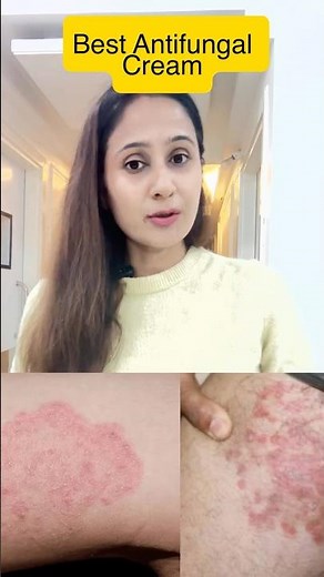 Fungal infection |Daad khaj |fungal cream|jock itch treatment