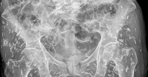 Nightmare Creatures: Doctor Astonished After Patient's X-Ray Shows Body Infested With 'Innumerable' Larvae