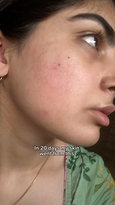 99K views · 5.1K reactions | 20 days challenge to glass clear skin. Best for acne prone skin dark spots dark circles and Pigmentation.Made with NIACINAMIDE,mendalic acid,Kojic acid,alpha arbutin and many more. For more details: Msg Us on our insta page Contact / whatsapp: 03461575618 Email: www.havelyn.pk@gmail.com Website : www.havelynpk.com | Havelyn_pk skinstore | Facebook