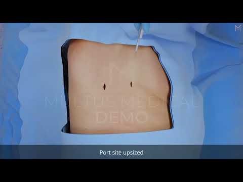 Visualizing Severe Rib Trauma | Rib ORIF After Motor Vehicle Collision