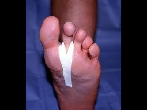 Ball of the Foot Joint Pain & Toe Capsulitis [Home Treatment Guide!]