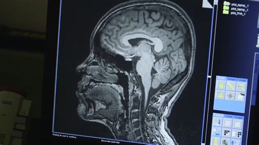 New UCLA AI tool targets Alzheimer's cases often missed in early diagnosis