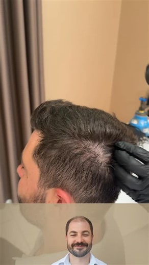 Serap Çınar | Acıbadem on Instagram: "Saç foliküllerinde dormant (uykuda) kök hücreleri, bitkisel aktifler + nano taşıyıcı moleküller sayesinde yeniden aktive ettik. DHT baskılamadan kontrol altına alan doğal esterler, vitamin kompleksleri ve soğuk plazma etkisiyle saç köküne oksijen difüzyonunu artırdık. Sonuç: kan dolaşımı artışı, hücresel yenilenme ve kalıcı kök aktivasyonu. 🔬 Resmî Belgeler ve Onaylar 1. T.C. Sağlık Bakanlığı UTS (Ürün Takip Sistemi) Kaydı → Tüm ürünlerimiz UTS üzerinden ka