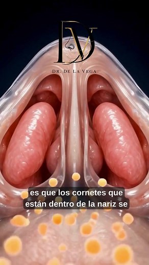 Por qué se te tapa la nariz cuando tienes alergia? 🤧 #rinitis #sinusitis #otorrino #otorrinolaringologia #medicina