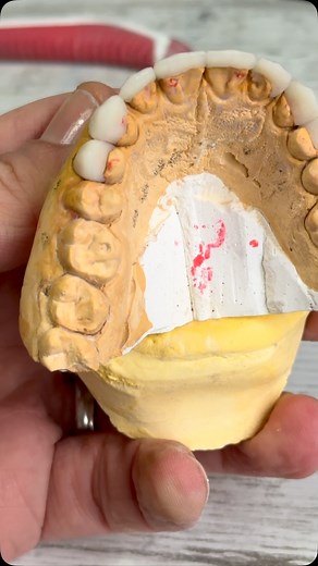 Some magic 🪄. #emax #ivoclar #veneers #glaze #finish_up | Dental World