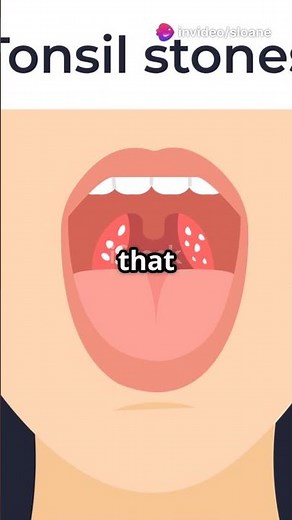 🦷 Why Your Tonsils Grow Stinky White Pebbles (And How to Remove Them!)