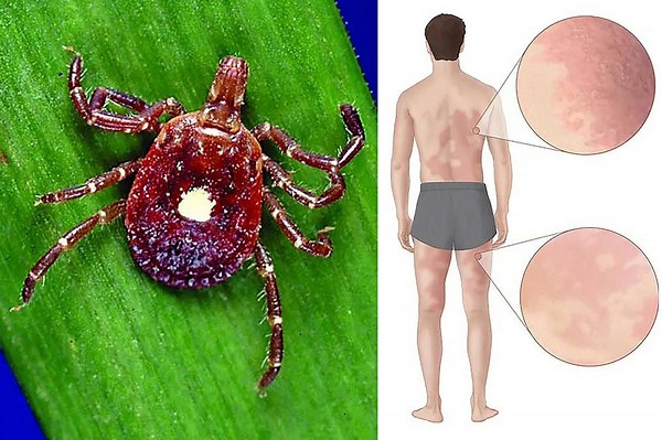 These ticks can cause an awful allergy to meat from just a single bite