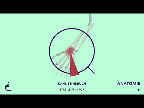Was ist eine Kahnbeinfraktur?