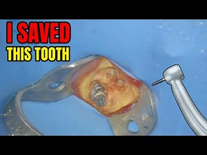Retreatment of a Tooth. Full Case