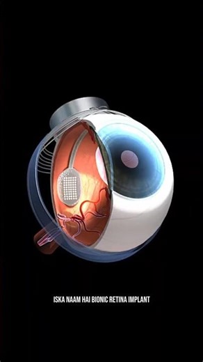 DAY 70/100 Bionic Eye Breakthrough
