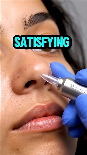 Nose Tip Blackhead Removal | The Most Satisfying Pop Ever!