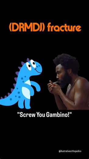 illustrative Ortho on Instagram: "⚠️ For young surgeons: I don't think Childish Gambino will approve this memeonic but his dance moves almost fit every song! Now to business... Distal radius meta-diaphyseal junction (DRMDJ) fracture is a special type of fracture first proposed by Lieber in 2010. DRMDJ differs from both metaphyseal and radial shaft fractures and here’s why: DRMDJ fractures have a distinct anatomical profile: (1) the site involves part of the tendon–muscle transition zone and lack