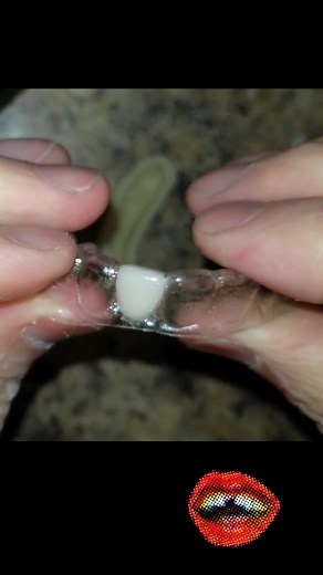 Creating Fake Tooth with Acrylic | Invisalign Teeth and Retainer