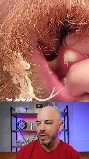 Lip pimple gone wrong! #pimplepop #dermreacts #lippimple #satisfying