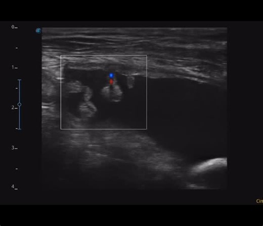 Ecografía veterinaria on Instagram: "Cistitis polipoide Canino, 12 años, bulldog Francés, castrado, con antecedentes de urolitiasis y cistitis crónica Se evidencian múltiples lesiones pedunculadas que se proyectan desde la pared ventro-craneal hacia la luz de la vejiga. #ultrasonidovet #ultrasonidoveterinario #ultrasoundveterinary #ultrasoundvet #ultrassonografiaveterinária"