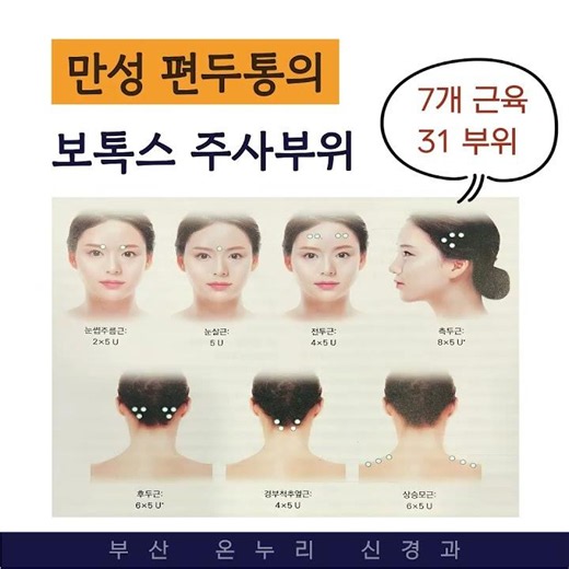 만성편두통 환자를 위한 보톡스 치료 정보 [부산신경과]