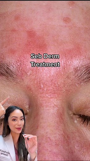 for my flaky besties 🥹 #seborrheicdermatitis #dermatologist #yourdermbff #sebderm