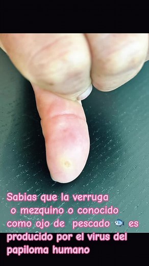 Tratamiento de Verrugas en Manos: Crioterapia y Consejos de Dermatología