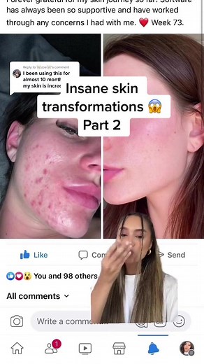 Replying to @🦷zoe🦷 Part 2 of insane Software custom skincare transformations 😱 we’re here supporting your skin journeys - you got this!! #skintransformation #skincare
