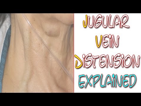 What Is Jugular Vein Distention | Something In About 5 Minutes | Medic Materials