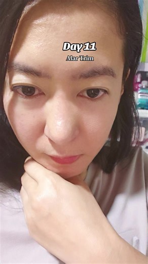 Alar Trim Healing Process: Day 11 Insights