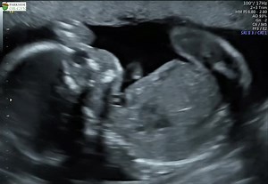 23M views · 79K reactions | Got to see my perfect son today 殺 One thing was discovered at the anatomy scan today, we go to a maternal fetal specialist in the coming weeks to see more specifically what we are dealing with. Nothing life-threatening, but pray all is well and that no intervention will be needed! | Living in the Light | Facebook