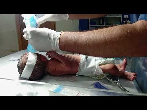 Newborn baby how to Pass an NG Tube in NICU | Step-by-Step Nasogastric Tube Insertion for Newborns