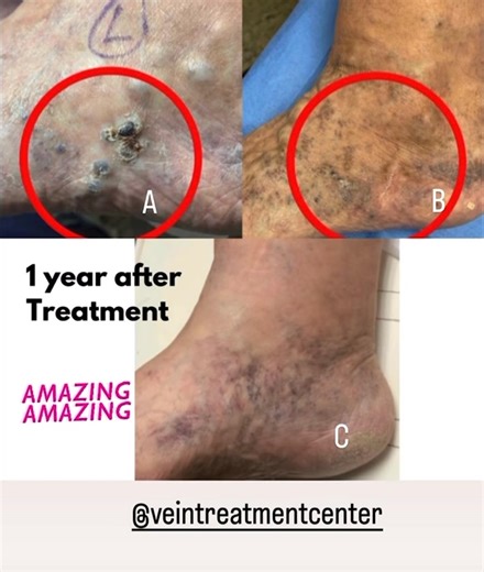 One year after treating this ankle for large bleeders that formed a scab. Microphlebectomy performed with sclerotherapy. Image B is 3 months after treatment. Image C is 1 year after treatment. These images are from my practice. @veintreatmentcenter on IG @sclerotherapyvids on IG (my second channel) www.VeinsVeinsVeins.com @BuffaloVeins on #YouTube VeinsVeinsVeins.com on #TikTok 5225 Sheridan Dr, Williamsville, NY 3680 Eggert Road, Orchard Park, NY #spiderveins #Escleroterapia #sclerotherapy #Scl