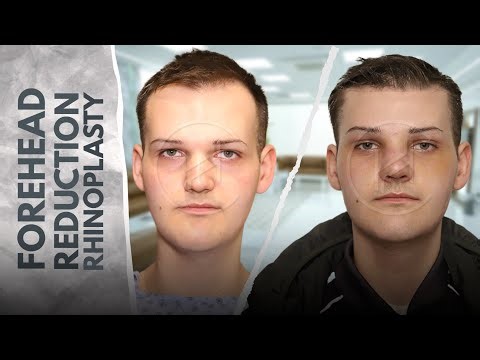Male Forehead Reduction + Rhinoplasty Result | Facial Balance Before & After | Heva Clinic