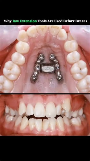 Knowledge Spectrum on Instagram: "Jaw extension tools are often used before braces because they help correct skeletal imbalances in the jaw that braces alone cannot fix, especially in growing patients. When the upper or lower jaw is too narrow or positioned incorrectly, simply straightening the teeth would place them into a misaligned foundation, which can lead to bite problems, relapse, or uneven facial development. Jaw expanders and other orthopedic appliances guide jaw growth, create proper s