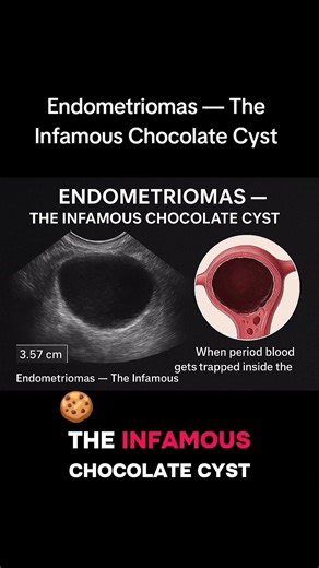 Chocolate cyst #ChocolateCyst #EndometriosisAwareness #OvarianHealth #PelvicPainRelief