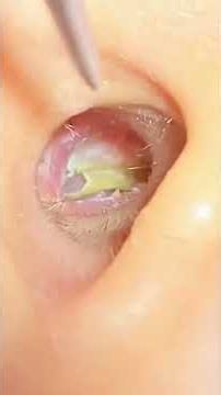 #relax#acne#satisfying#asmr#earwaxremmoval#earcleaningvideos#earwaxcleaning#ceradeouvido