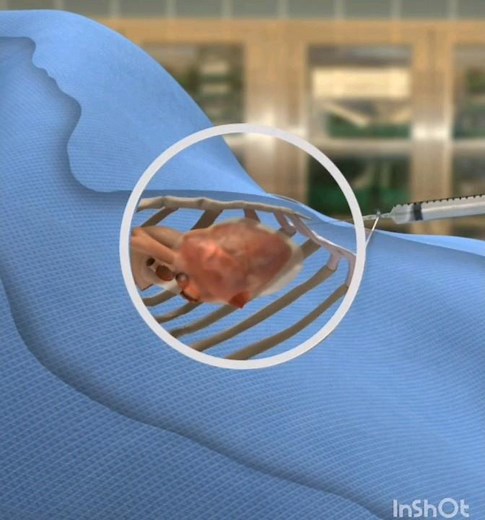 Emergency Pericardiocentesis #surgery #operation #short