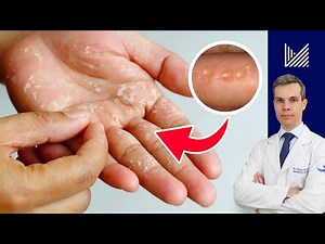 Dyshidrosis: Itchy Bumps on Hands and Feet? Causes and Treatments!