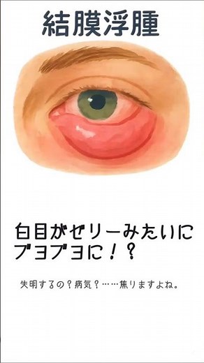 白目が腫れても焦らないで！「結膜浮腫」の原因と正しい治し方 #shorts