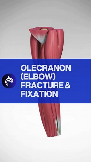 See how it's fixed: Elbow Fracture and Fixation. #elbow #surgery Mechanism of Injury: Olecranon fractures often result from a direct blow to the elbow, such as falling onto a hard surface with the elbow extended or directly hitting the elbow. They can also occur indirectly from a sudden contraction of the triceps muscle, which can pull a fragment of the olecranon off. Treatment Options: Treatment depends on the type and severity of the fracture. Non-displaced fractures, where the bone pieces are