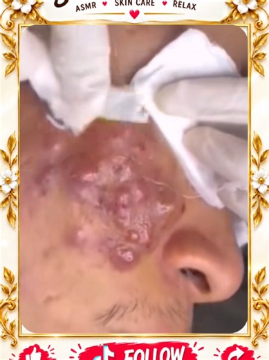 Deep Blackhead Extraction & Satisfying Popping | Wait for the most satisfying pop 😳🫣 You won’t believe what comes out! #pimplepoppersatisfying #Acne #pimple #Blackhead #Satisfying