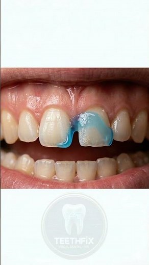 Gap Between Front Teeth Closed | Smile Transformation with Composite Bonding
