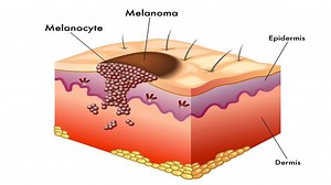 Understanding Melanoma - AIM at Melanoma Foundation