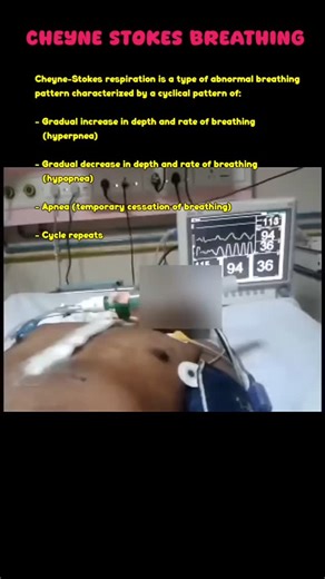 Divin LK on Instagram: "Breathing... then silence... then gasping. Meet Cheyne-Stokes respiration #cheynestokes #respiration #abnormalbreathing #cardiology #neurology #medicalreels #medfacts #breathingpatterns #sleepdisorders #healthawareness #medstudent #nursingeducation #clinicalsigns #centralapnea #heartfailure"