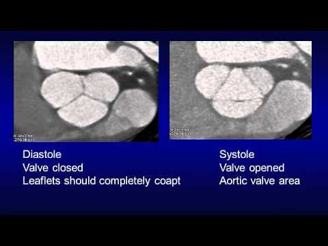 When do I have to perform a gated chest CT?