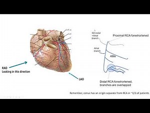 Coronary angiography tips
