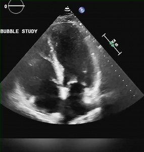 Intra Extra cardiac shunt | Cardiophilia