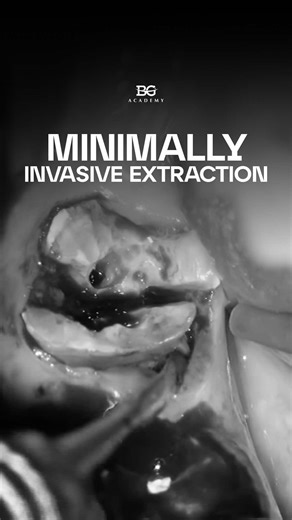Minimally invasive extraction technique for mandibular molars. Socket management using condensed collagen. Step-by-step protocol 1. Local anesthesia 2. Root separation - division of the mesial and distal roots 3. Selective root preparation with a surgical bur - removal or reduction of root fragments that obstruct the path of extraction 4. Severing the periodontal ligament using a desmotome, periotome, or mucotome 5. Root delivery using surgical forceps 6. Socket curettage and debridement — gentl