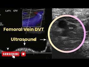 Femoral Vein DVT Ultrasound Appearance | Key Diagnostic Signs