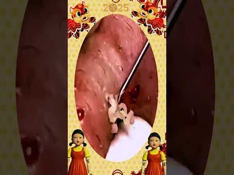 Blackheads Removal | old aged blackheads removal/ cystic blackheads whiteheads removal